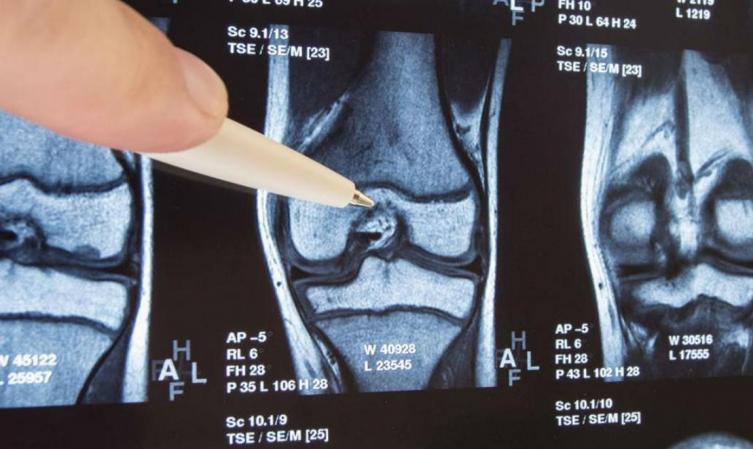 Científicos idean una terapia para regenerar los cartílagos con artrosis