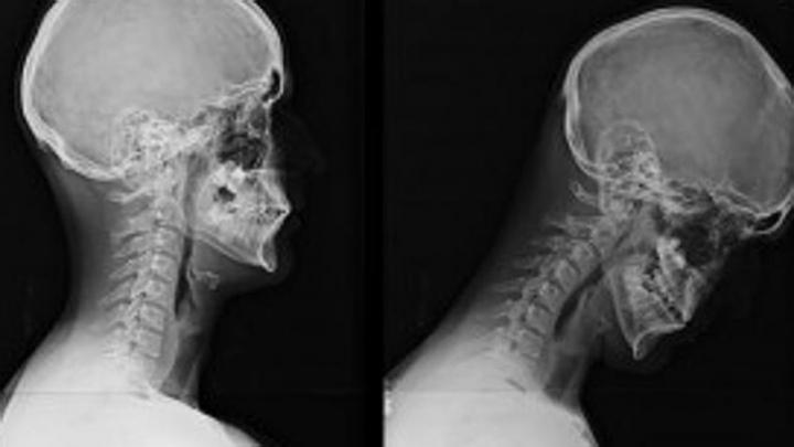 Los niños se vuelven “jorobados” por el uso de móviles