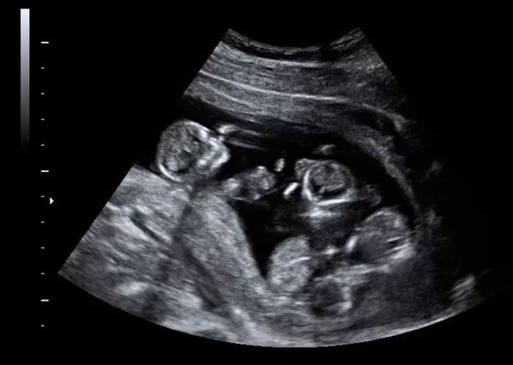 Nacieron trigemelas en La Pampa