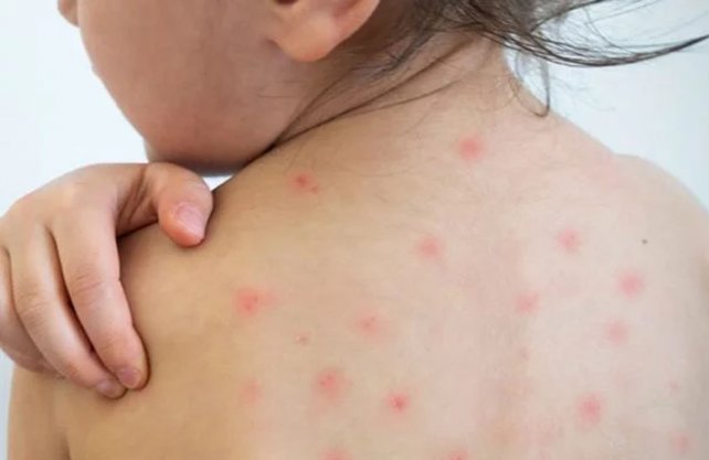 Una mujer antivacunas contagió a sus 5 hijos de sarampión