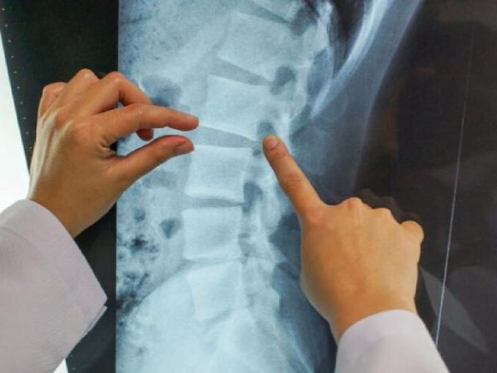 Logran el primer trasplante de vértebras humanas