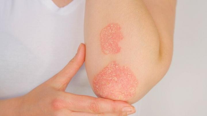 Psoriasis severa: lanzan terapia que la elimina en forma total