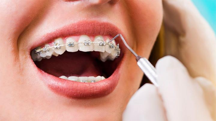 Prohíben dos modelos de brackets
