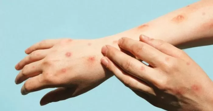 Viruela del mono en Santa Fe: informe epidemiológico