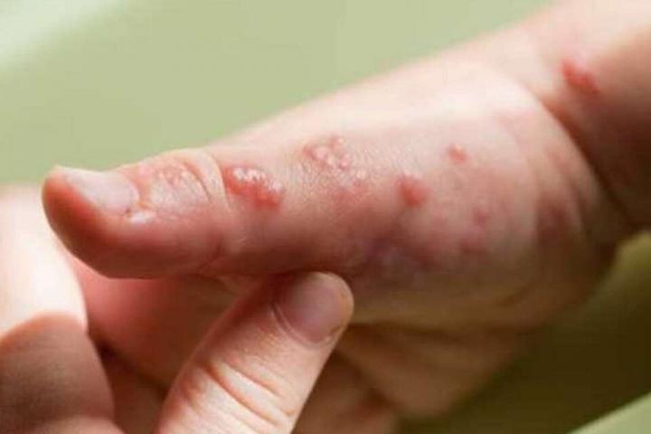 Viruela del Mono en Santa Fe: 2 casos confirmados y 1 sospechoso